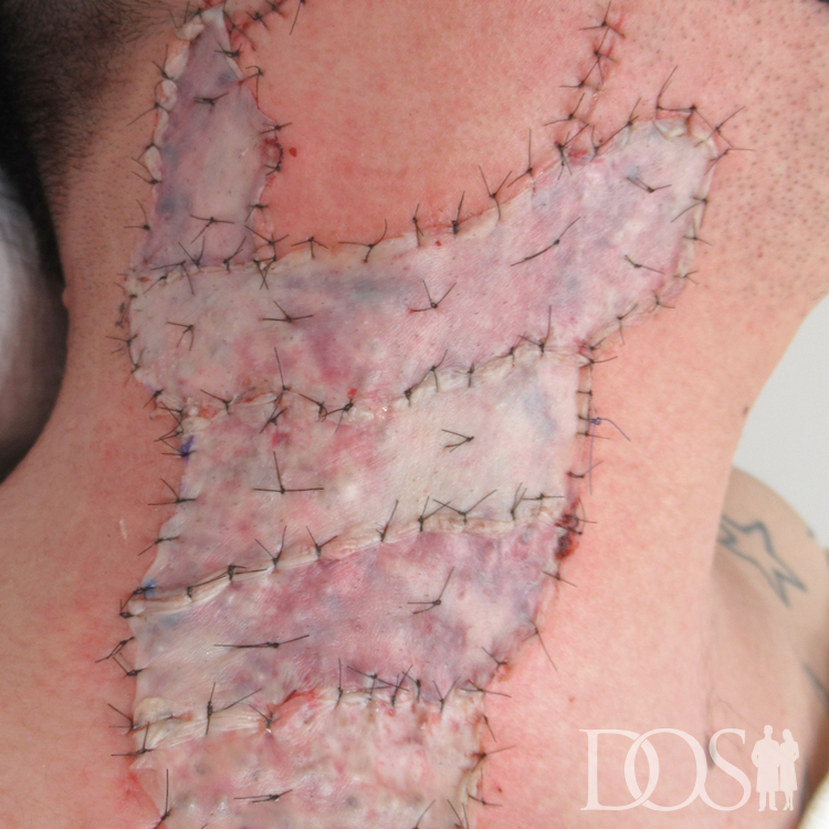 当院患者様：首のタトゥー タトゥー外科的切除法