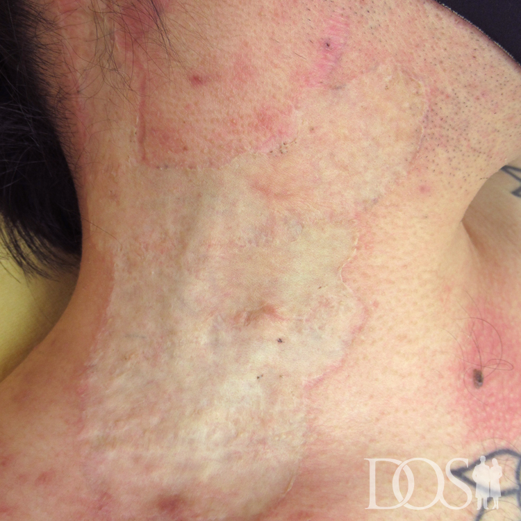 当院患者様：首のタトゥー タトゥー外科的切除法