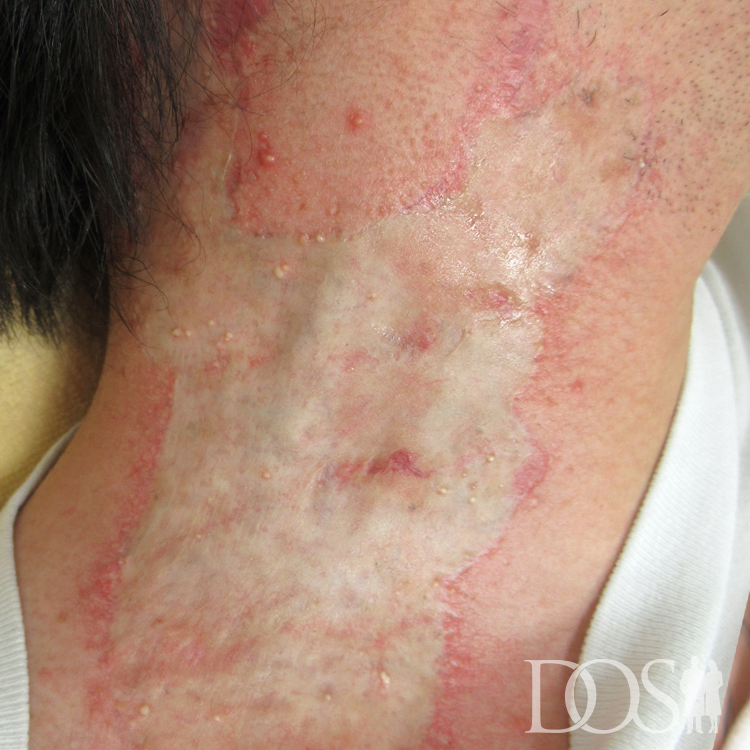 当院患者様：首のタトゥー タトゥー外科的切除法