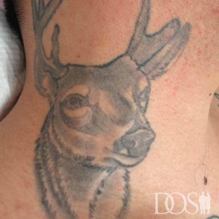 当院患者様：首のタトゥー タトゥー外科的切除法