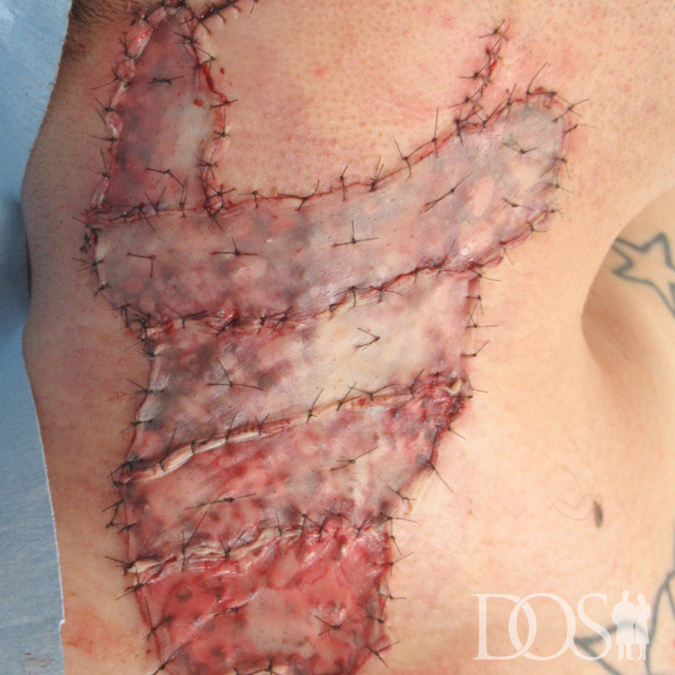 当院患者様：首のタトゥー タトゥー外科的切除法